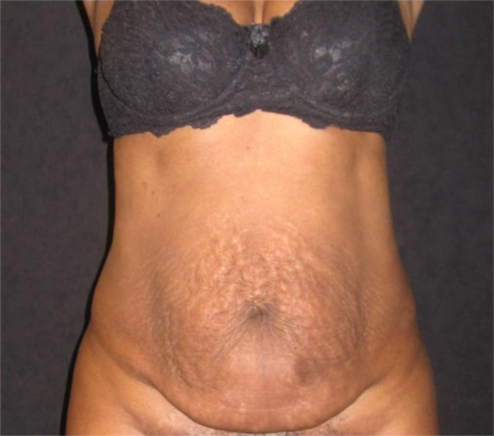 Abdominoplastia o “cirugía estética de abdomen” en mujer de 44