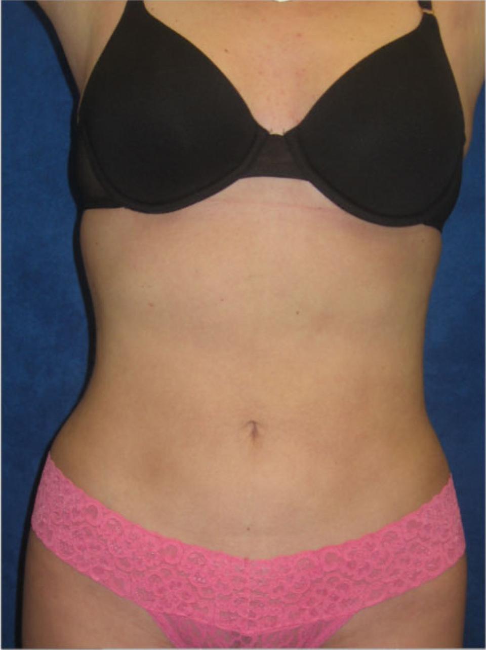 A, C, E) This 53-year-old woman presented for body contouring. (B